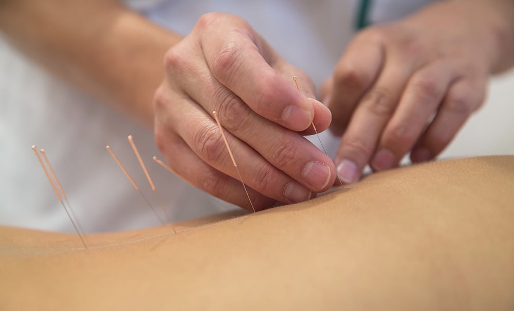 Acupuncture needles on back of a young woman