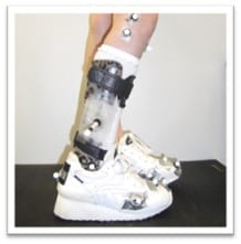 Figure 1: A CP child wearing an AFO with adapted footwear, used to optimise their prescription.